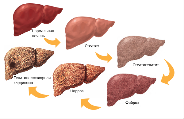 Печень алкоголика картинка